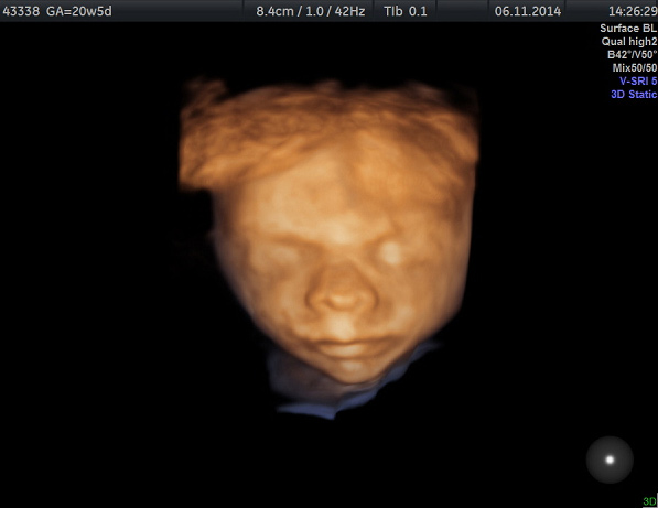 Baby Boy in 3D at 20 weeks 5 days