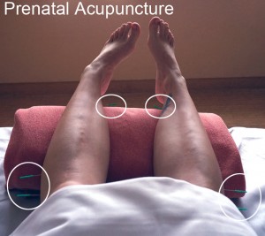 Prenatal Acupuncture - 36 weeks