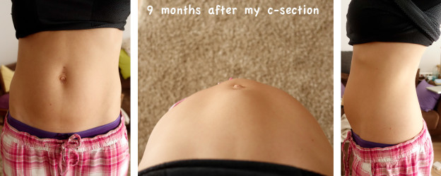 9 months after my C-Section